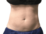 Coolsculpting® - Case 18571 - Before