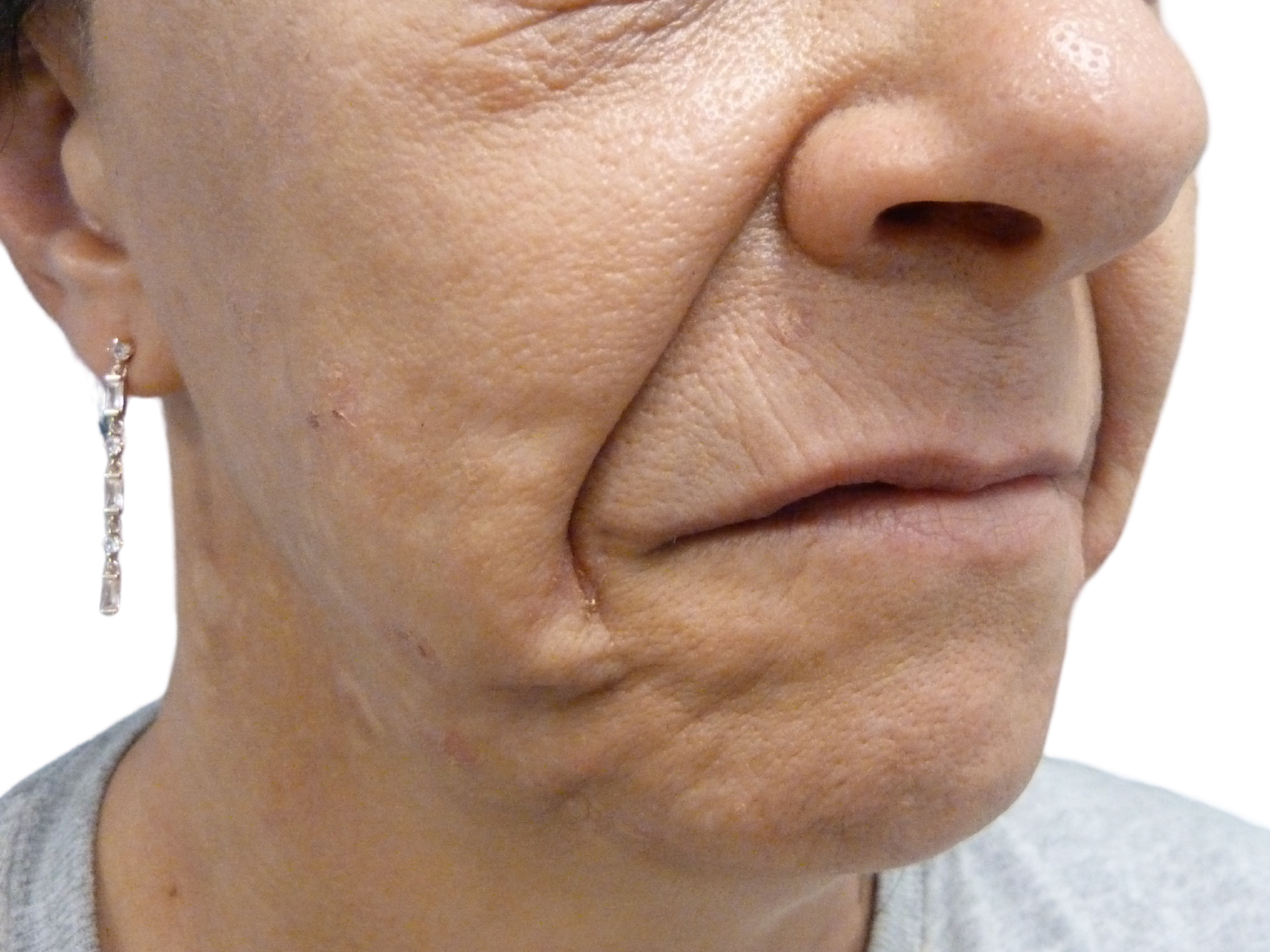 Injectable Fillers Patient Photo - Case 18652 - before view-0