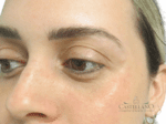 Injectable Fillers - Case 18657 - After