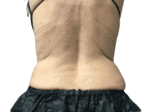 Coolsculpting® - Case 18662 - Before