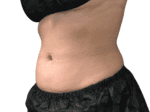 Coolsculpting® - Case 18853 - Before