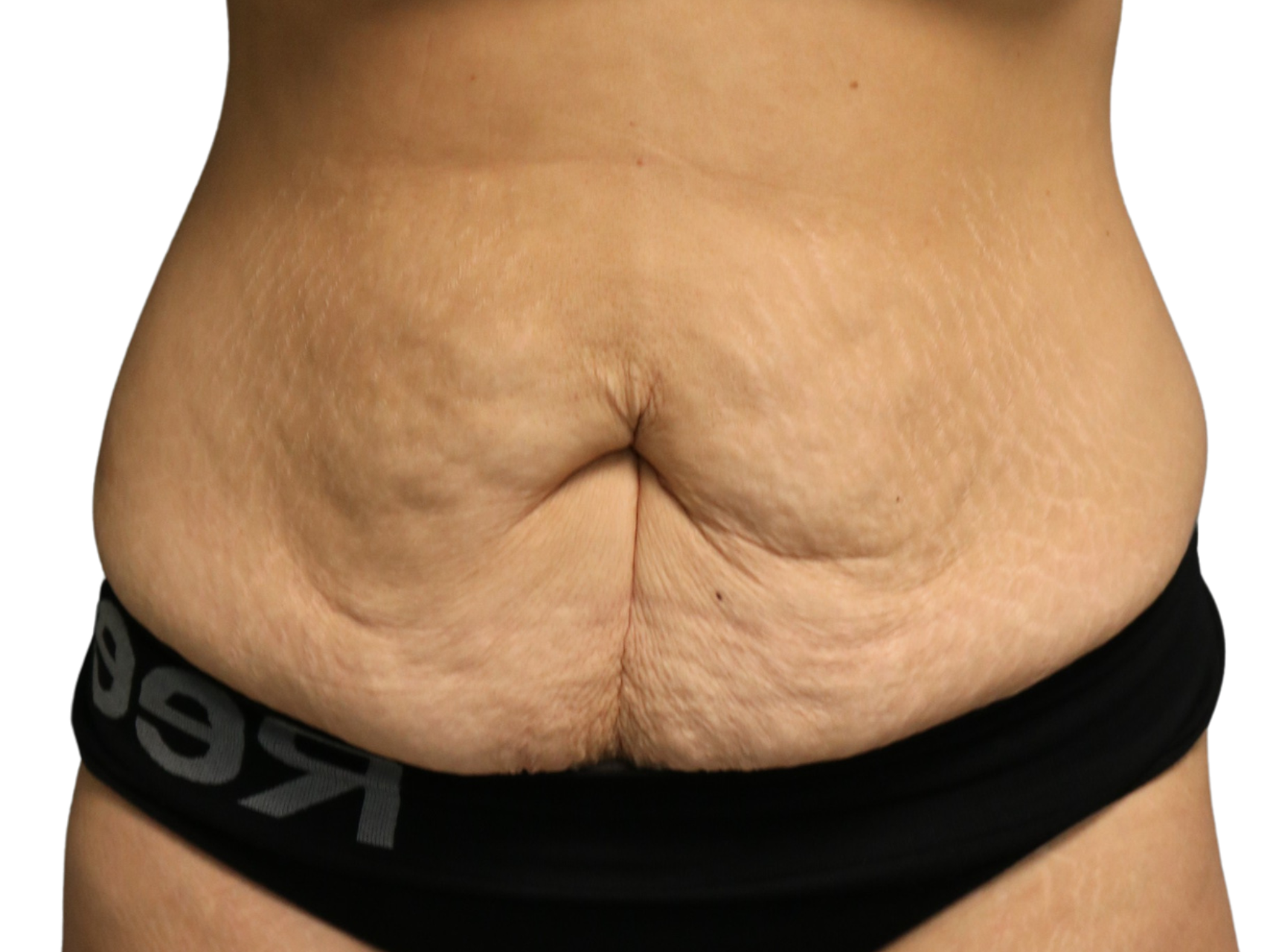 Tummy Tuck Patient Photo - Case 18859 - before view-0