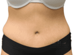 Tummy Tuck - Case 18859 - After