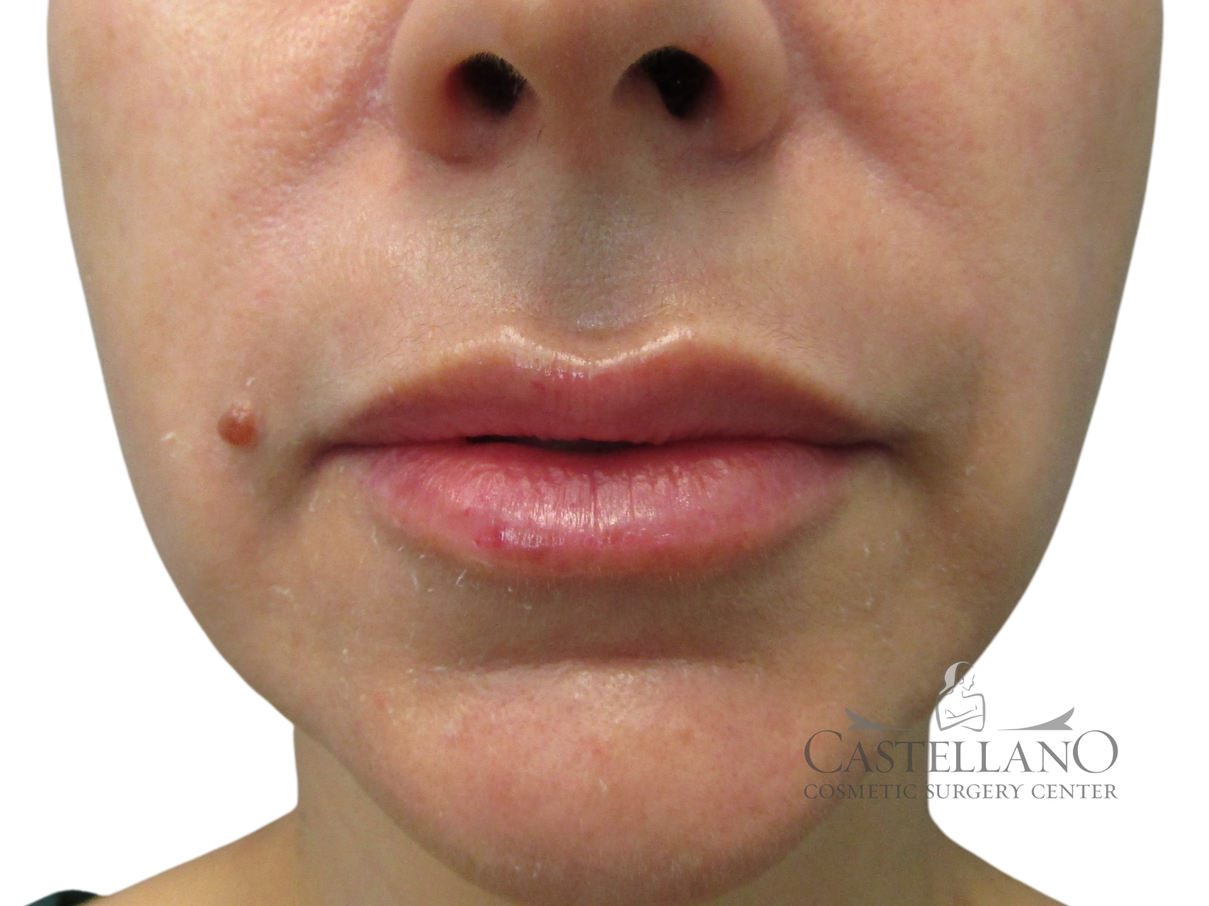 Lip Augmentation Patient Photo - Case 18886 - after view-0