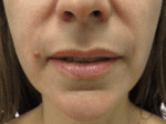 Lip Augmentation - Case 18886 - Before