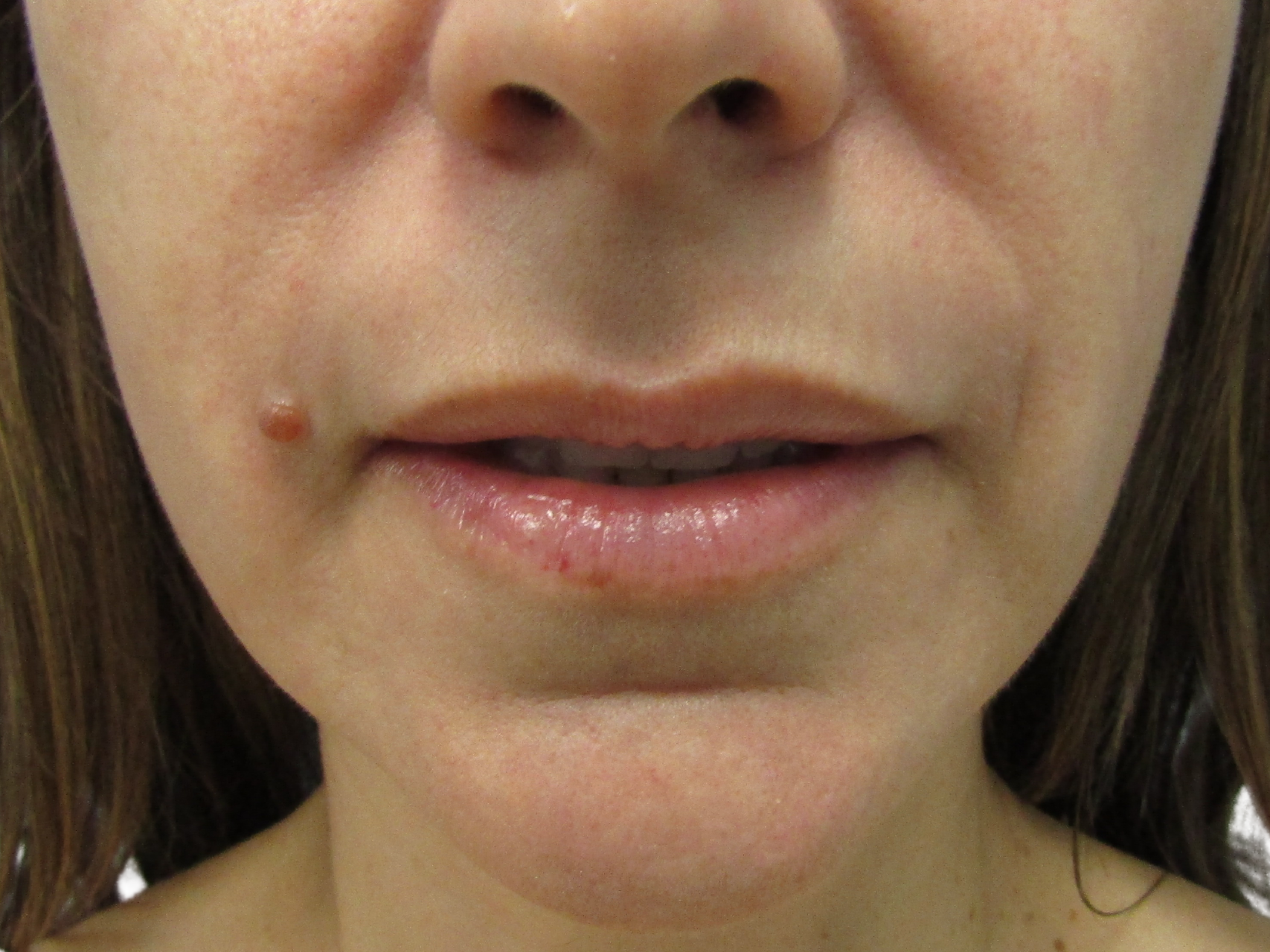 Lip Augmentation Patient Photo - Case 18886 - before view-0