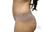 Tummy Tuck - Case 18920 - After