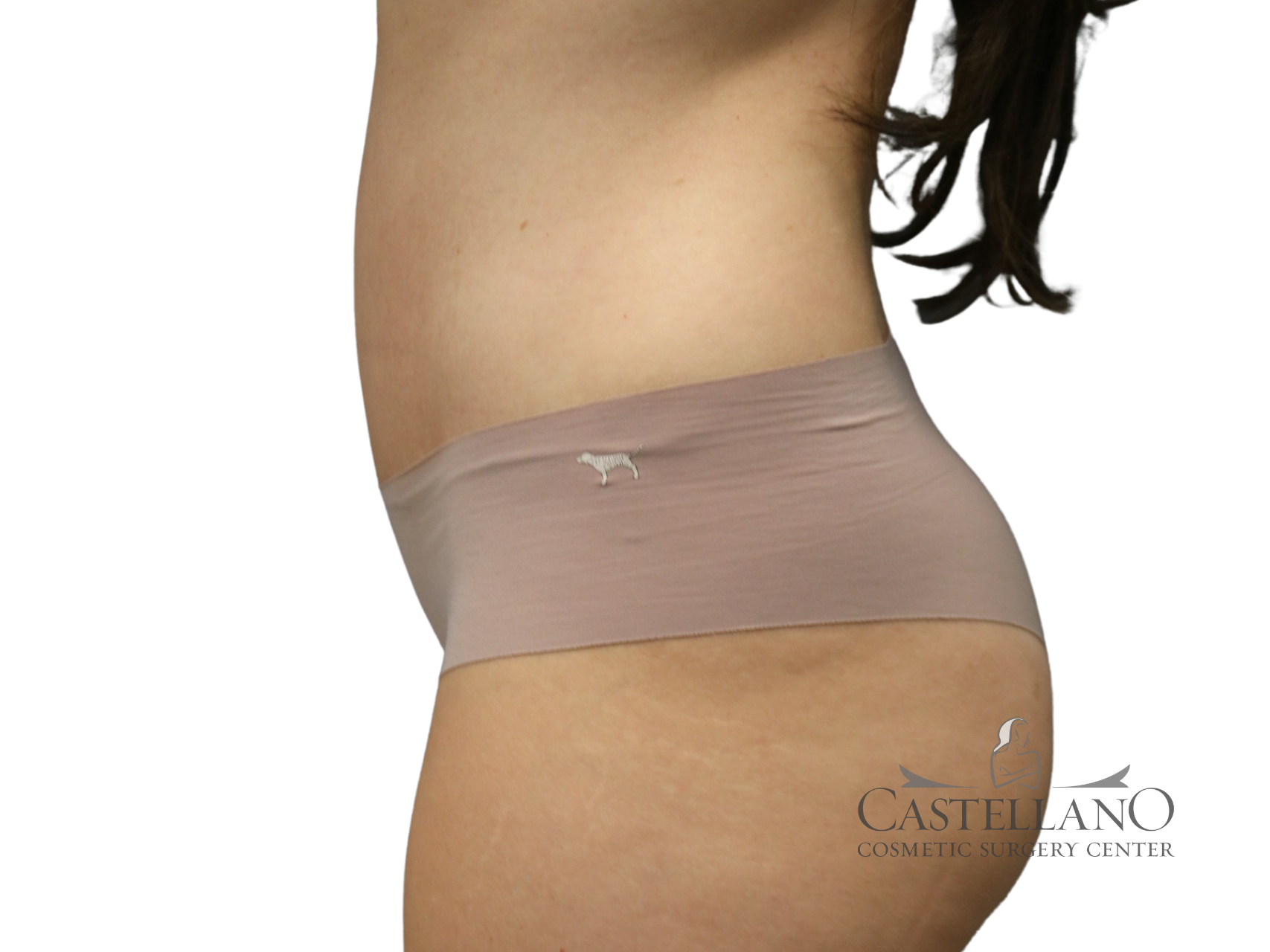 Tummy Tuck Patient Photo - Case 18920 - after view