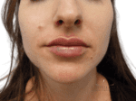 Lip Augmentation - Case 18928 - After