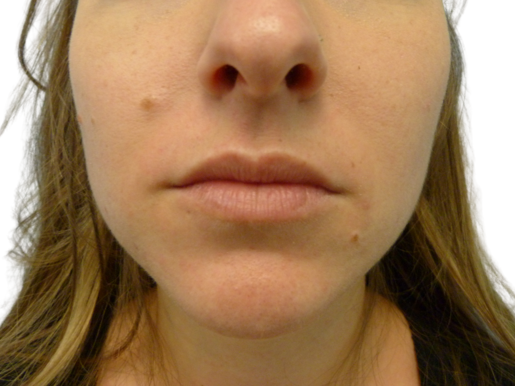 Lip Augmentation Patient Photo - Case 18928 - before view-