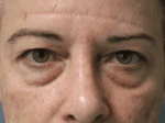 Eyelid Surgery - Case 19032 - Before