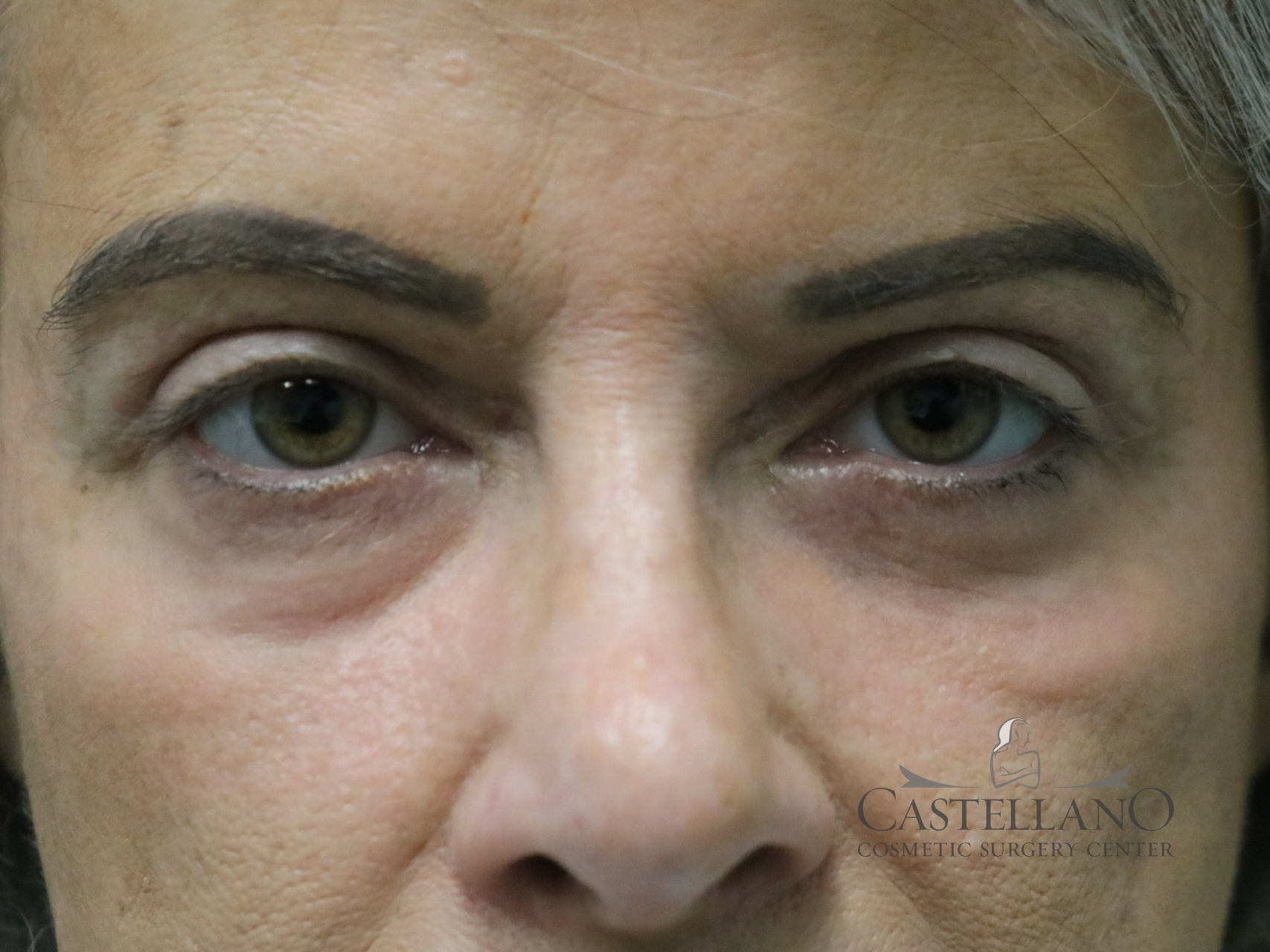 Eyelid Surgery Patient Photo - Case 19032 - after view
