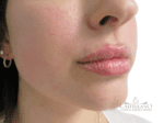 Lip Augmentation - Case 19037 - After