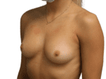 Breast Augmentation - Case 19045 - Before