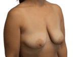 Breast Lift with Augmentation - Case 19050 - Before