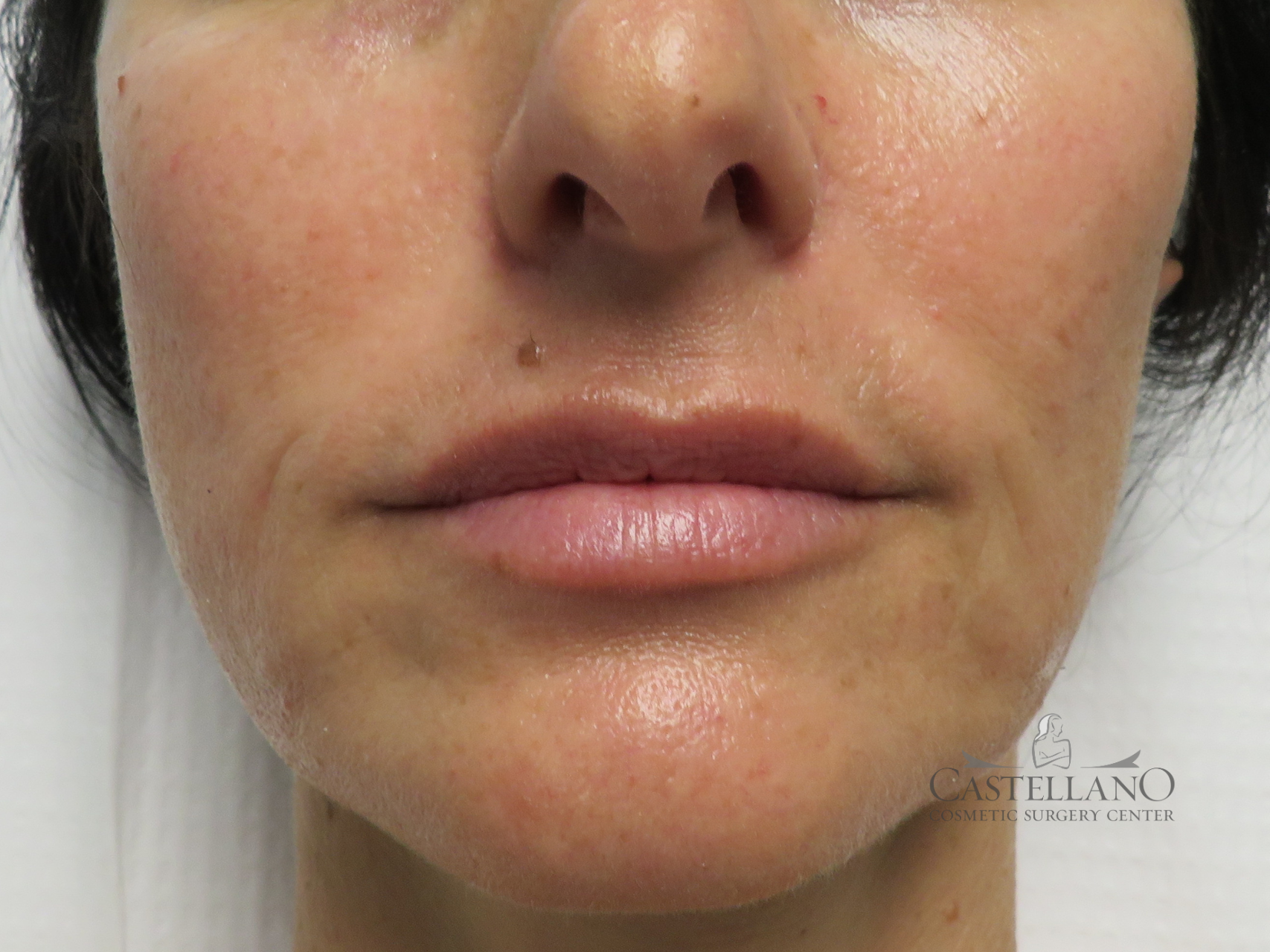 Lip Augmentation Patient Photo - Case 19116 - after view-0