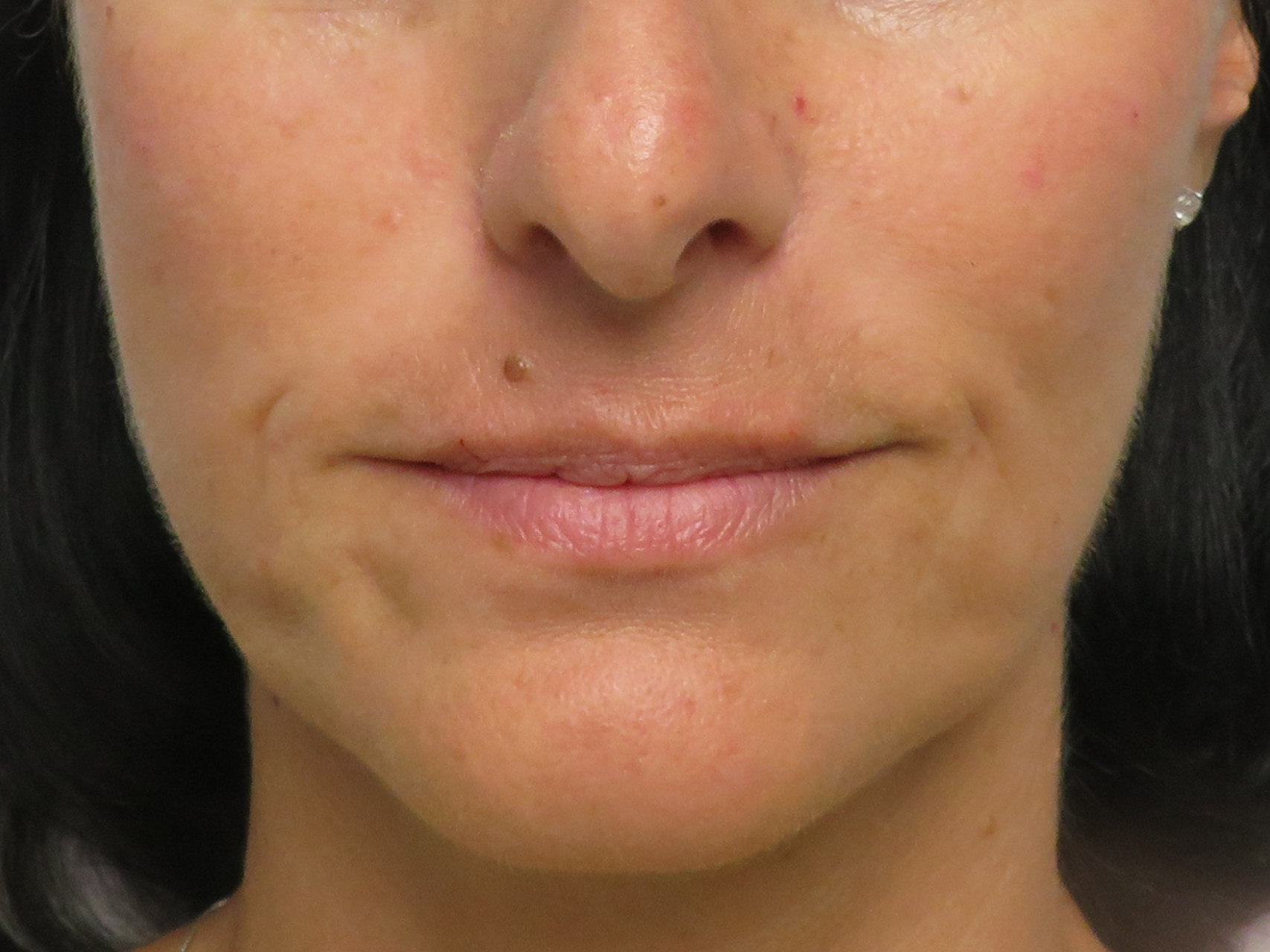 Lip Augmentation Patient Photo - Case 19116 - before view-