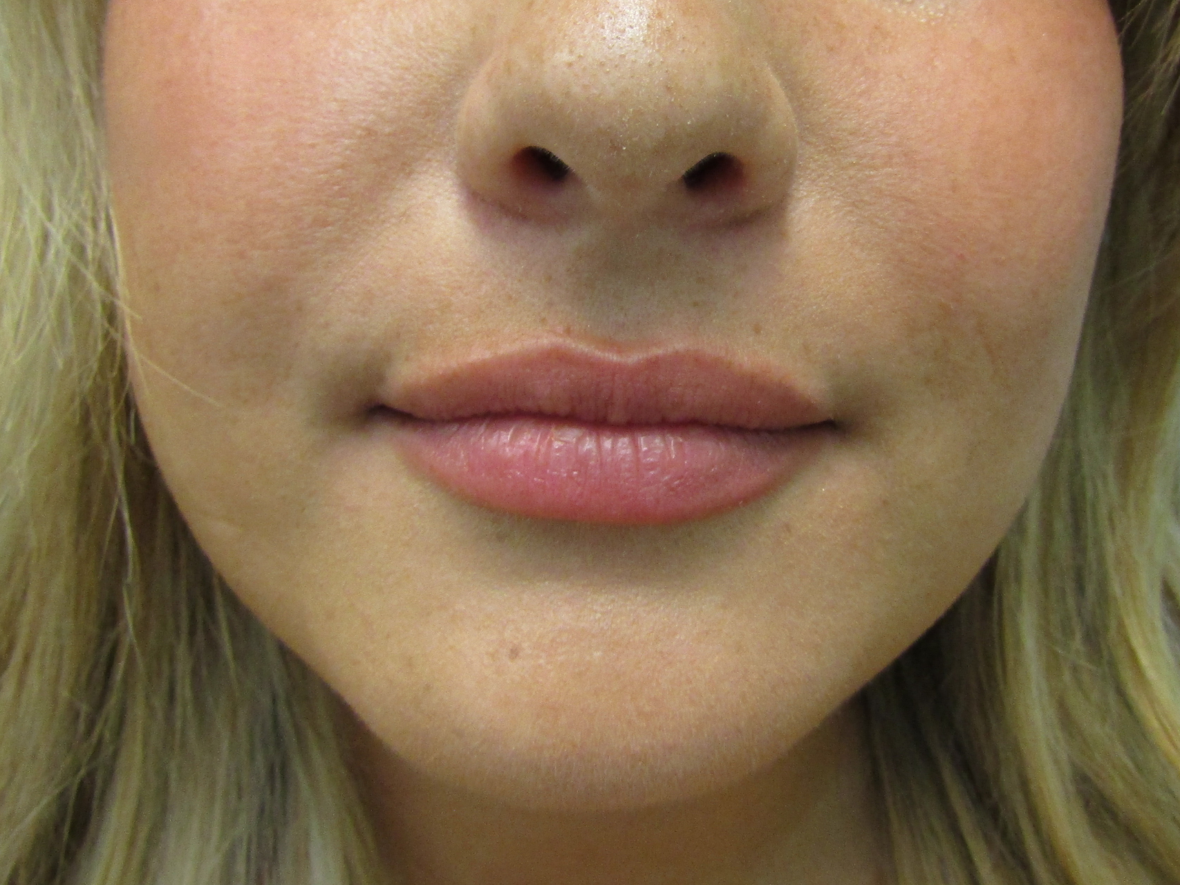 Lip Augmentation Patient Photo - Case 19210 - before view-