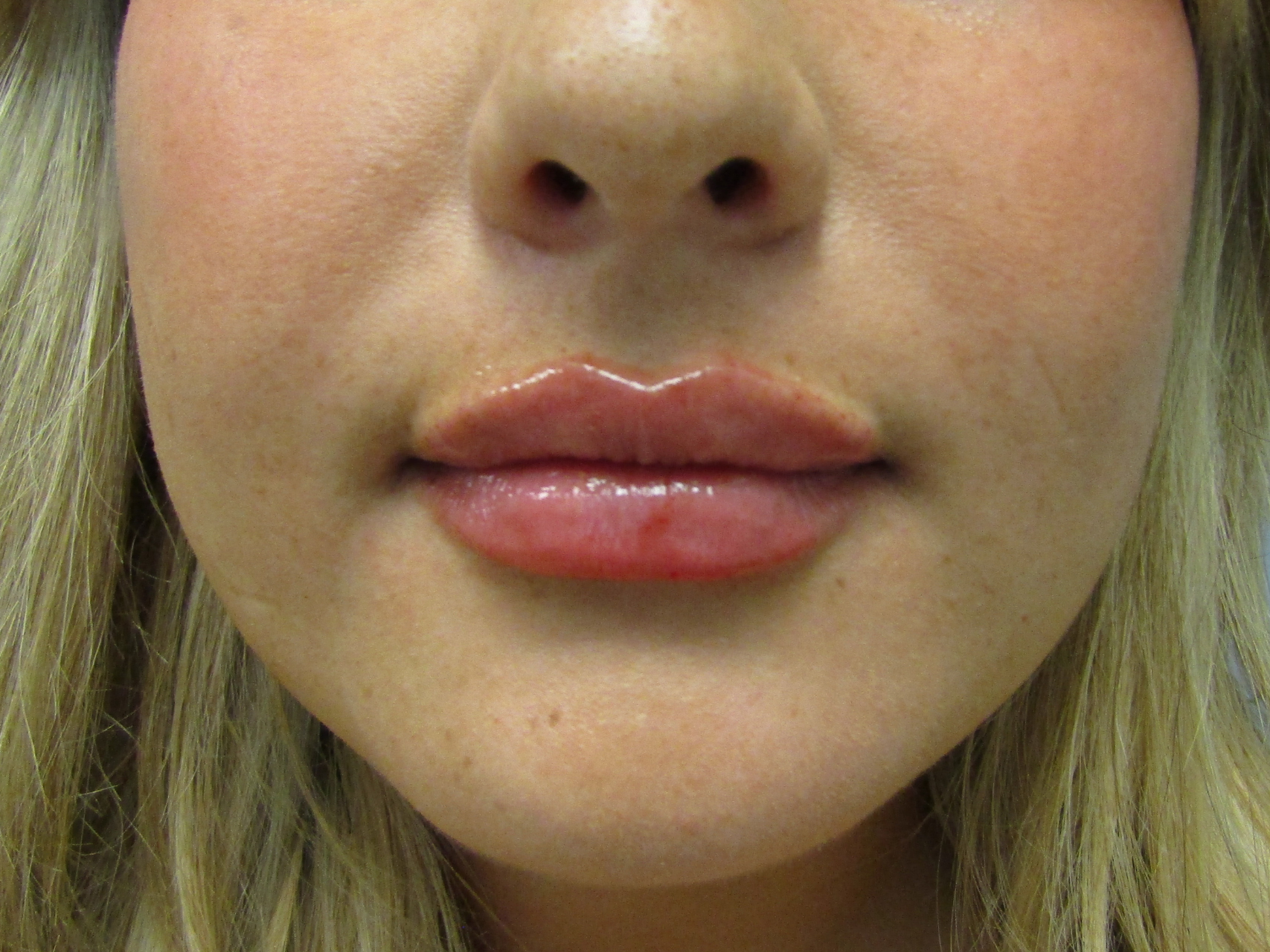 Lip Augmentation Patient Photo - Case 19210 - after view-0