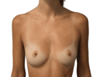Breast Augmentation - Case 19463 - Before