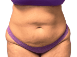 Tummy Tuck - Case 20563 - Before