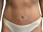 Coolsculpting® - Case 20576 - After