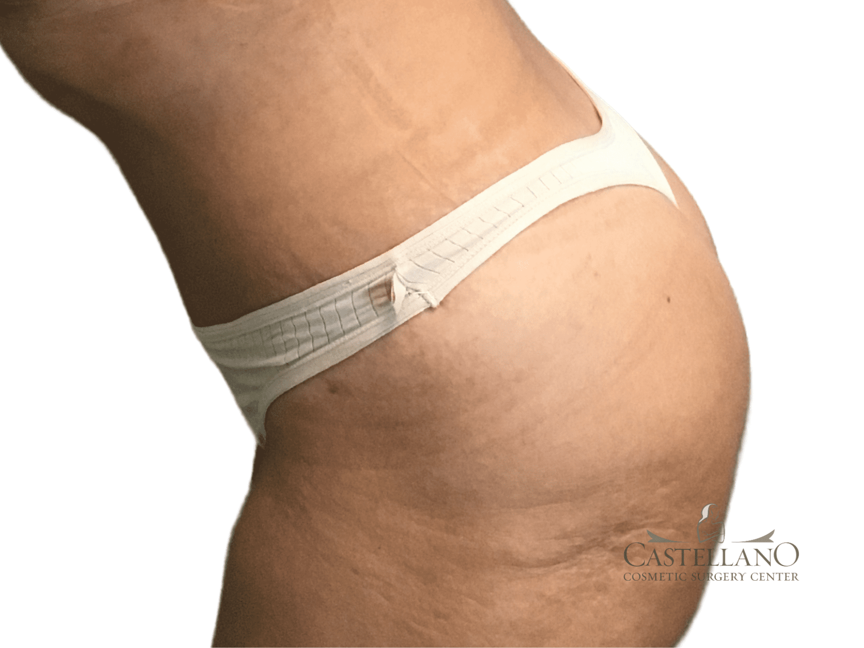 Coolsculpting® Patient Photo - Case 20576 - after view-1