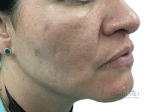 Laser Treatments - Case 20679 - After