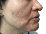Laser Treatments - Case 20679 - Before