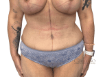 Tummy Tuck - Case 20690 - After