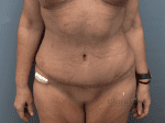 Tummy Tuck - Case 20703 - After
