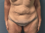 Tummy Tuck - Case 20703 - Before