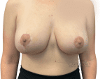 Breast Lift with Augmentation - Case 20708 - After