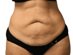 Tummy Tuck - Case 20792 - Before