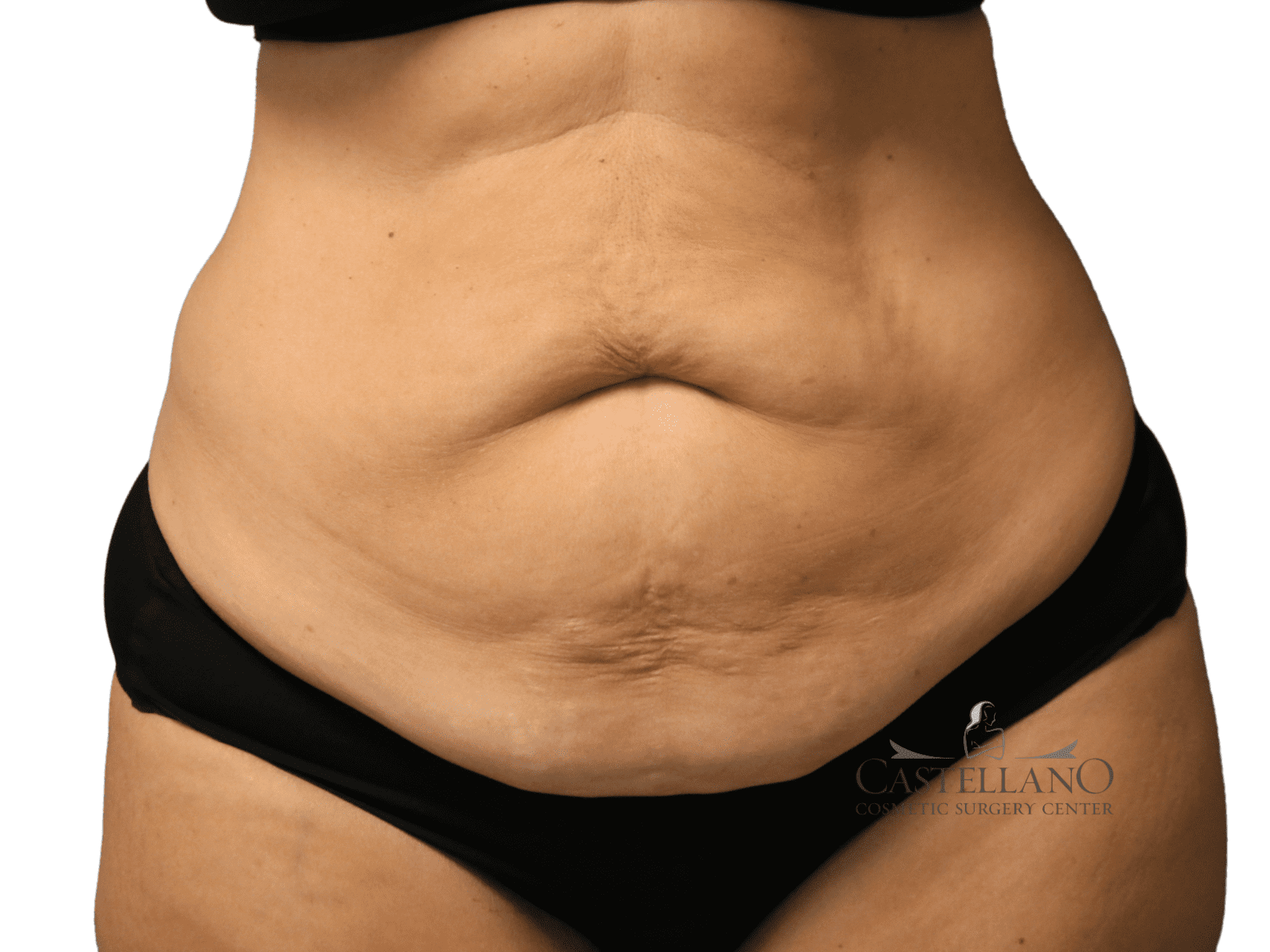 Tummy Tuck Patient Photo - Case 20792 - before view-