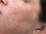 Laser Treatments - Case 20811 - After