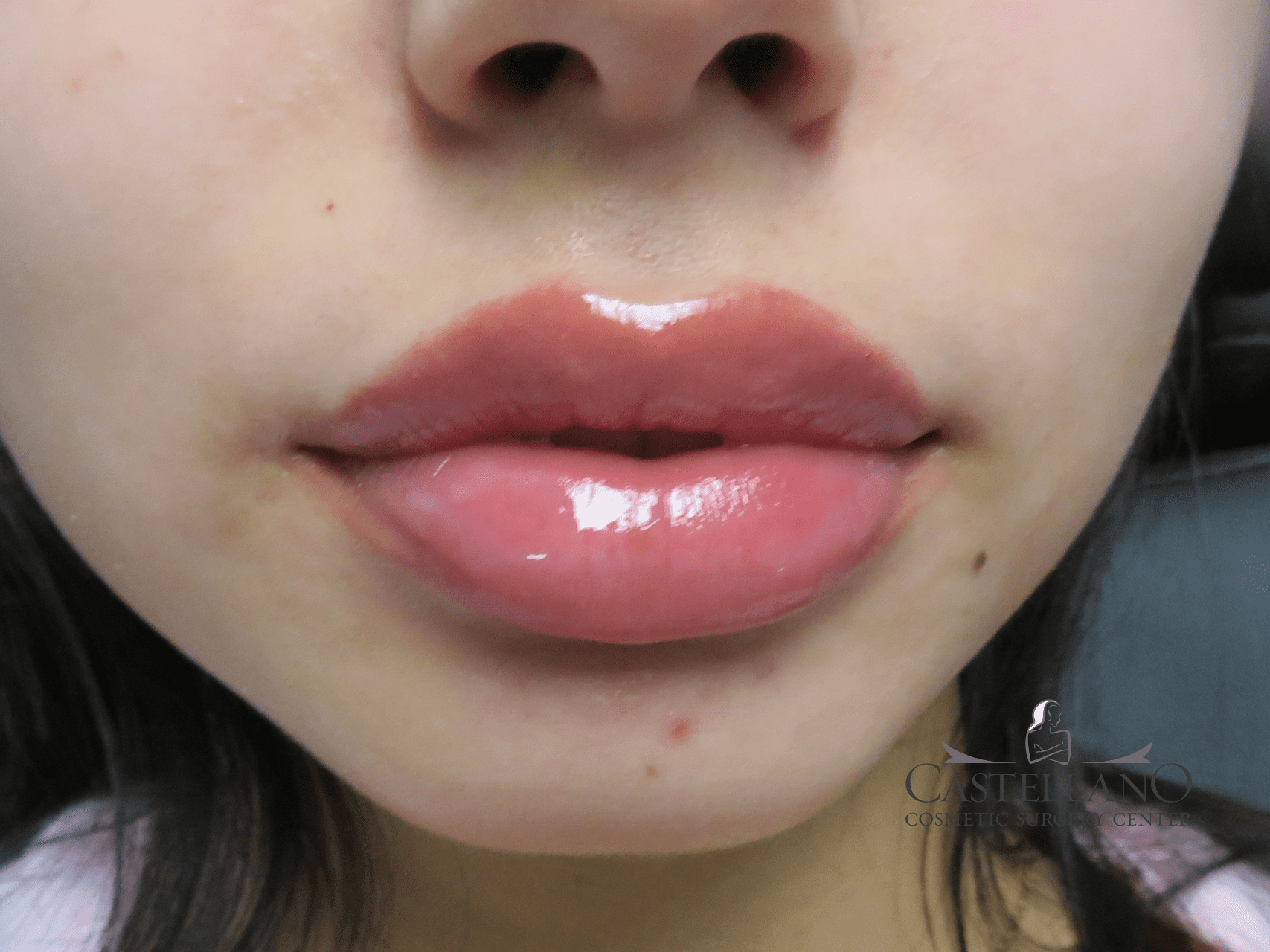 Lip Augmentation Patient Photo - Case 21086 - after view