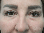 Laser Treatments - Case 21102 - After