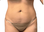 Tummy Tuck - Case 22396 - Before
