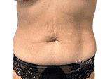Tummy Tuck - Case 22400 - Before