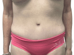 Tummy Tuck - Case 22400 - After