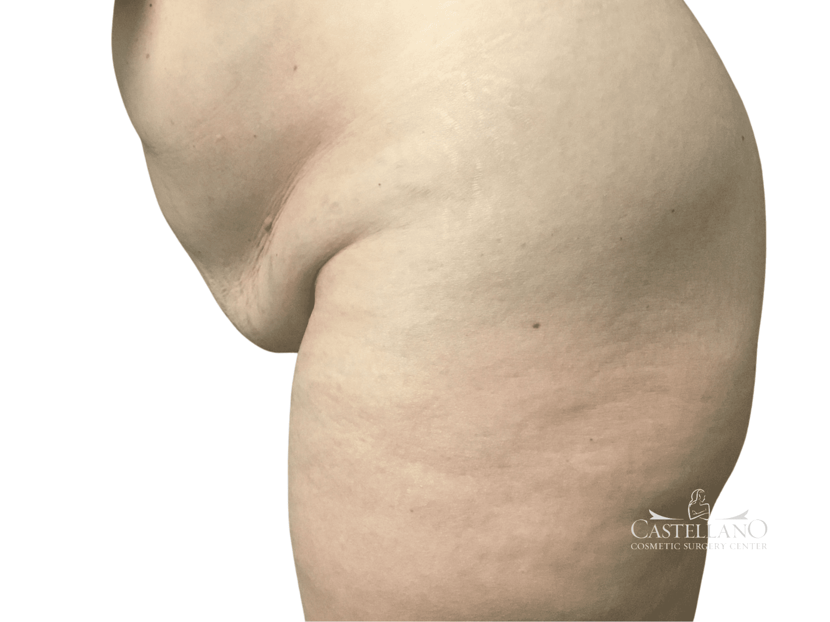 Tummy Tuck Patient Photo - Case 22422 - before view-