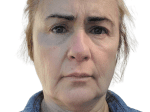 Laser Treatments - Case 22434 - Before