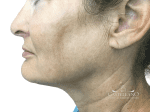 Laser Treatments - Case 22807 - After
