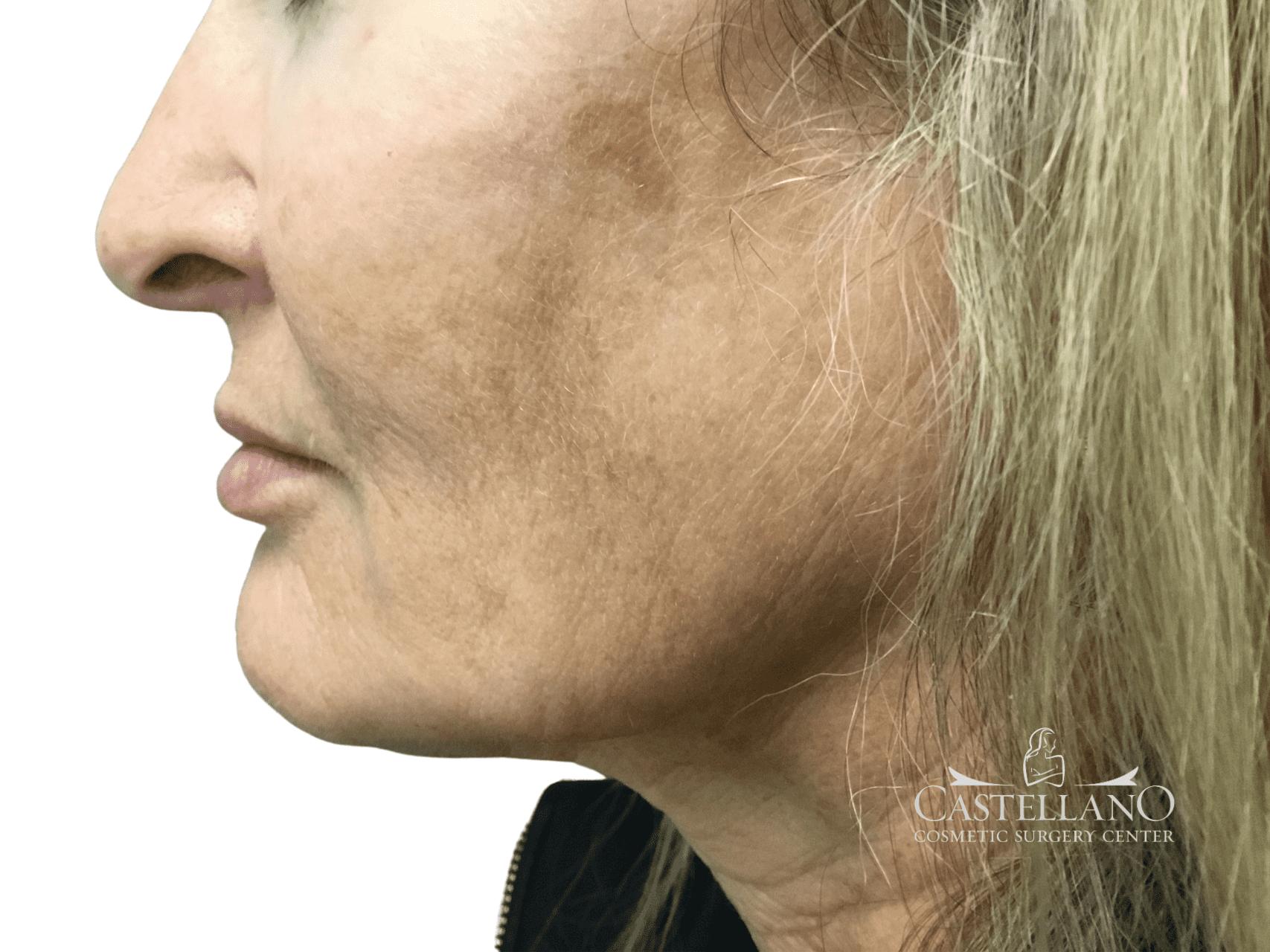 Laser Treatments Patient Photo - Case 22807 - before view-