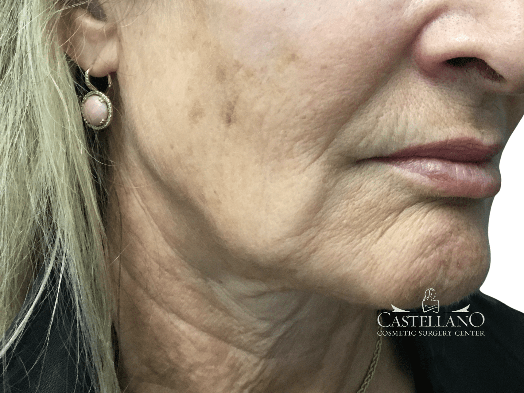 Laser Treatments Patient Photo - Case 22807 - before view-1