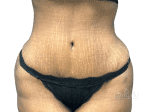 Tummy Tuck - Case 22814 - After
