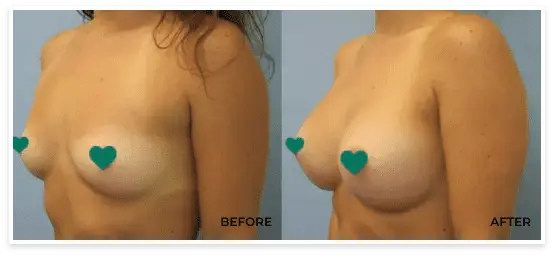 before after breast