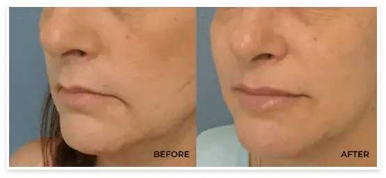 before after facial