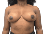 Breast Reduction - Case 23236 - After